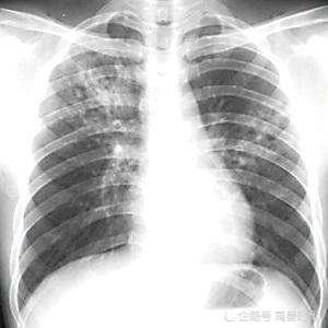 三大系列疾病可引发肺心病