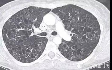 肺朗格汉斯组织细胞增多症和皮疹的关系