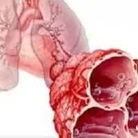 巨型肺大泡容易并发自发性气胸
